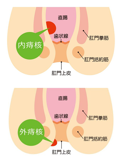 いぼ痔(痔核)