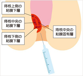 ジオン注射（ALTA療法）