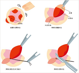 結紮切除術