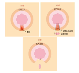 皮膚弁移動術（SSG）