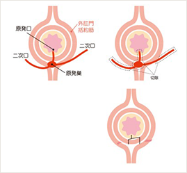瘻管切開開放術（lay open法）
