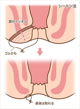 シートン法