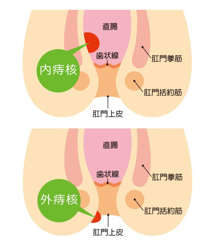 いぼ痔(痔核)