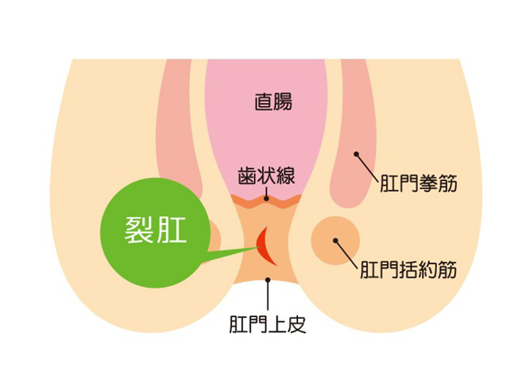 切れ痔(裂肛)