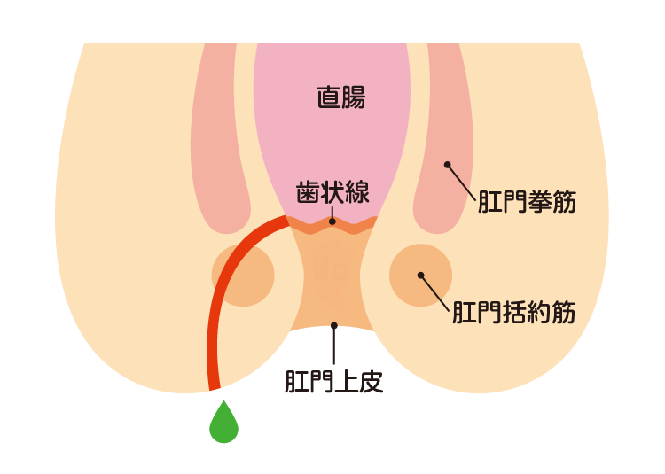 痔ろう(あな痔)